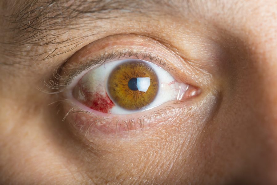 Conjunctivitis — red, inflamed eye with visible blood vessel dilation