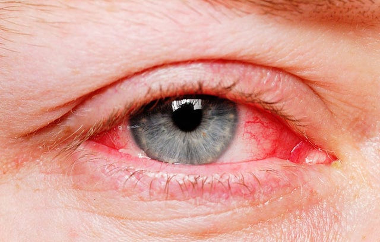 Close-up of a red, irritated eye
